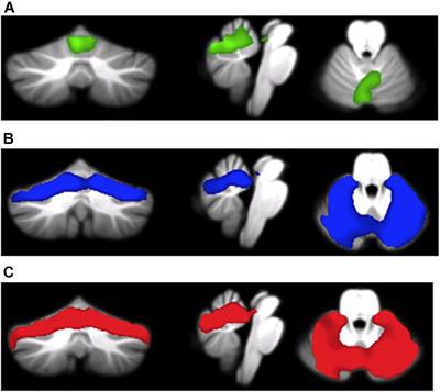 Patterns of Cerebellar Gray Matter Atrophy Across Alzheimer’s Disease Progression